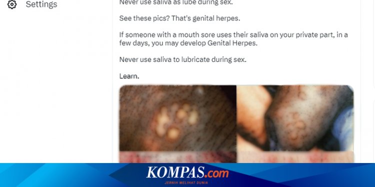 Benarkah Pakai Air Liur Saat Hubungan Seks Bisa Memicu Herpes Genital?