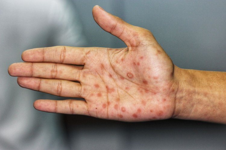 Penyakit Sifilis Meningkat 70 Persen, Pakar Tekankan Pentingnya Kesetiaan