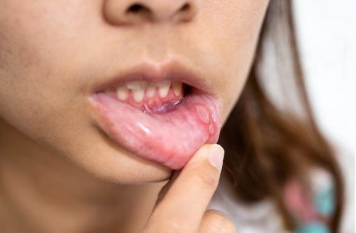 Sariawan Bisa Menjadi Tanda-tanda Kanker Mulut, Ketahui 8 Penyebabnya