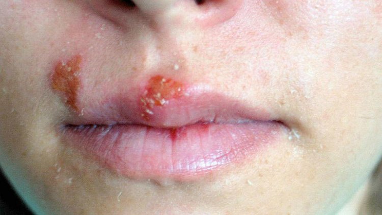 8 Cara Mengobati Herpes di Wajah, Redakan Rasa Sakitnya