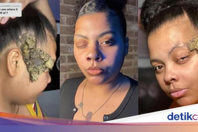 Viral Wanita Kena Kelainan Genetik, Dikira Tanda Lahir Lalu Melebar dan Berbau