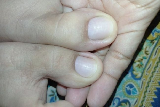 Bahaya Cantengan dan Cara Mengatasinya