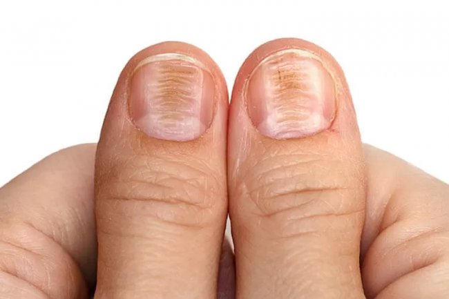 Atasi Penyakit Beri - Beri dengan Buah Nanas, Begini Cara Raciknya