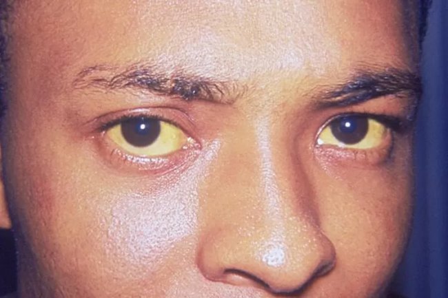 Obat Apotek yang Mujarab Untuk Penyembuhan Penyakit Mata Kuning, Sangat Mengganggu Penampilan