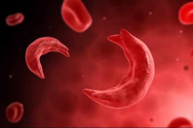 Hari Kesadaran Sel Sabit Sedunia 19 Juni, Penyakit Langka Sel Darah Merah Berbentuk Bulan Sabit