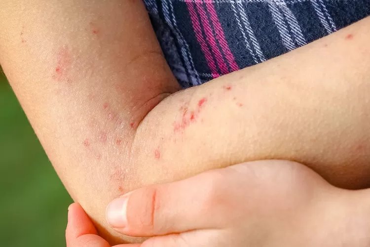 4 Cara Mengobati Penyakit Dermatitis dengan Bahan Alami, Nomor 2 gak Disangka