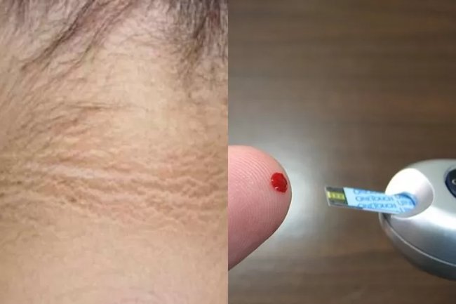 Apa itu Diabetes Insipidus? Simak Penjelasan Lengkap Mengenai Gejala-Gejala, Serta Penyebabnya