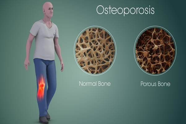 Ini Lho Penyebab Utama Osteoporosis pada Perempuan