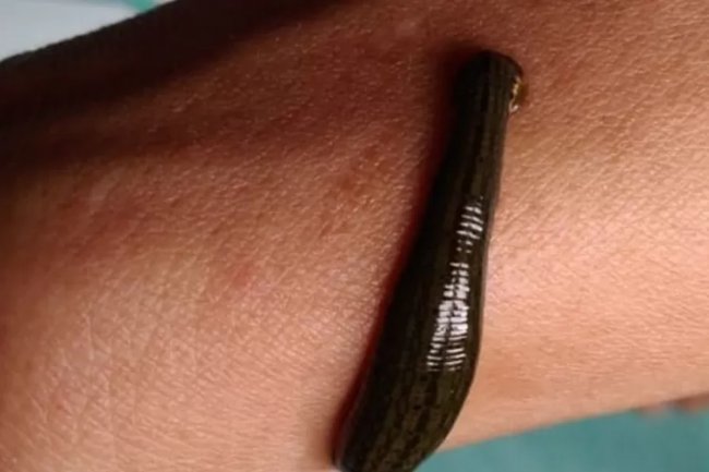 Menakjubkan! Ini 5 Manfaat Terapi Lintah Bagi Kesehatan Tubuh, Dapat Mencegah Pertumbuhan Sel Kanker Loh!