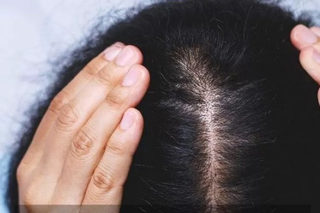 Tips Mengurangi Rambut Rontok dan Ketombe, Ayo Ladies merapat!