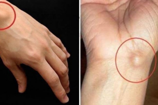 Tahukah Kamu? Ini Perbedaan Benjolan Tumor dan Kista yang Wajib Diketahui
