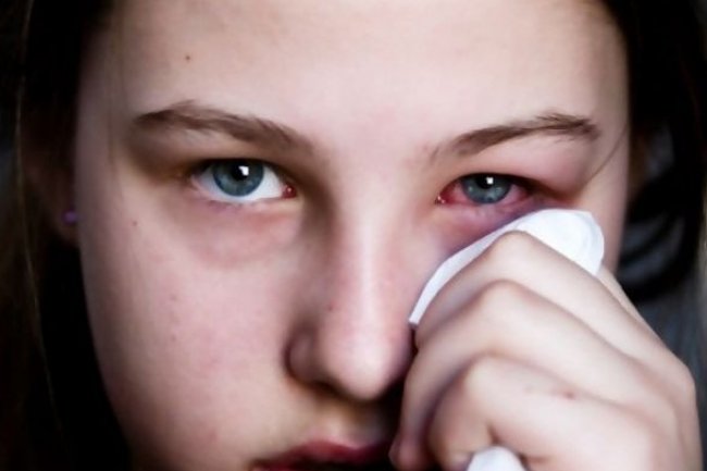 8 Cara Menghilangkan Mata Sembab dengan Cepat dan Alami, Mata Sembab Langsung Hilang!