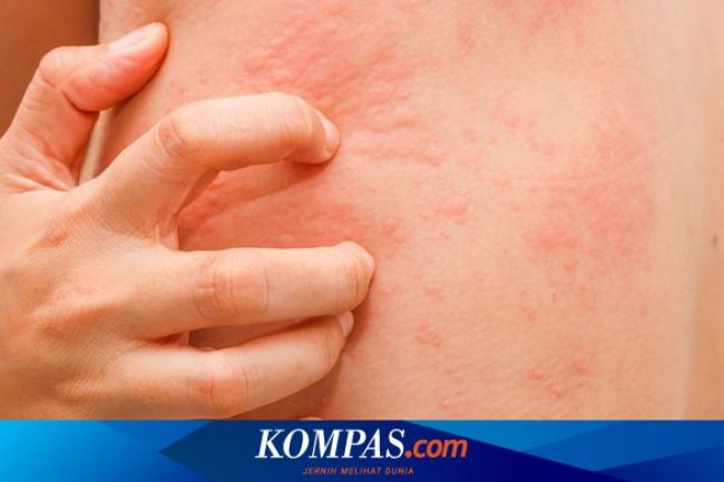 Apakah Penderita Biduran Boleh Mandi?
