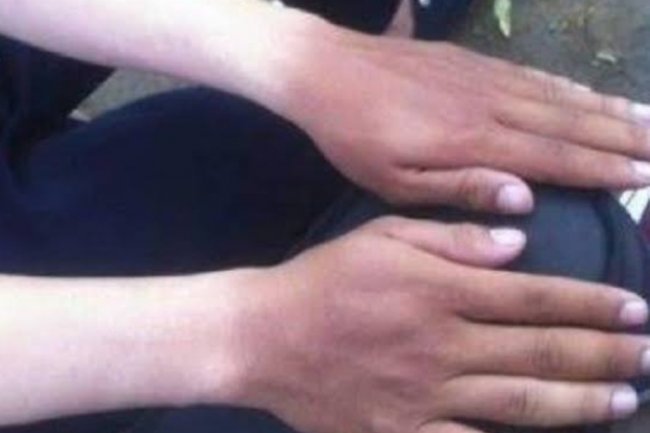 Cara Kembalikan Kulit Belang Akibat Sinar Matahari