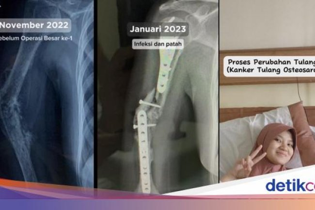 Viral Dialami Wanita Bandung, Dokter Ungkap Beda Pegal Biasa Vs Kanker Tulang