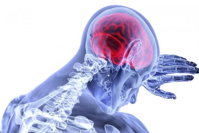 SIMAK! 6 Alasan Mengapa Usia Muda Tetapi Sudah Terserang Stroke