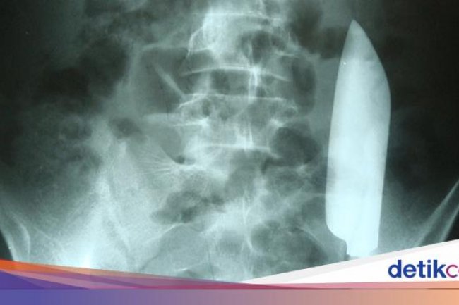 Ngeri! Ada Pisau Nyangkut di Perut Pria Ini, Kok Bisa?