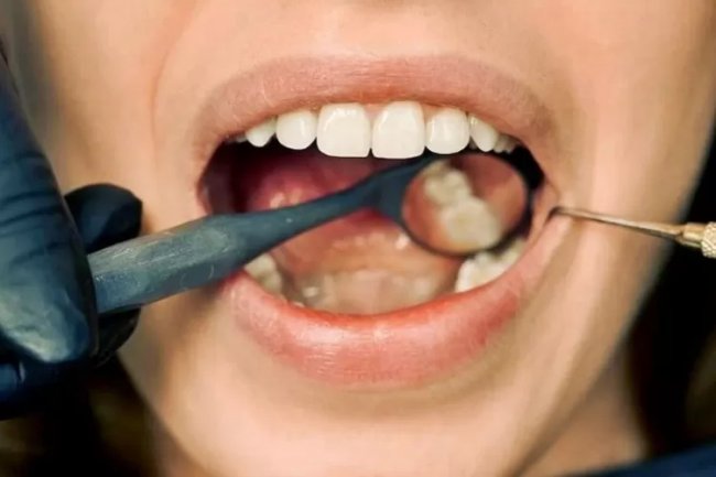 Tak Perlu ke Dokter, Begini 5 Cara Mengobati Gusi Bengkak di Rumah