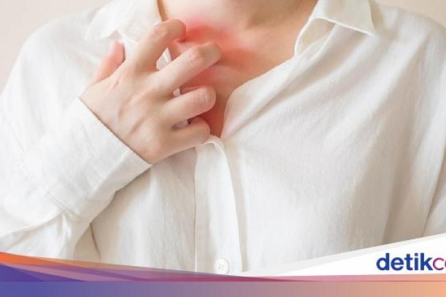 Biang Keringat Terasa Gatal dan Mengganggu, Gimana Mengatasinya Dok?