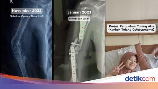 Viral Dialami Wanita Bandung, Dokter Ungkap Beda Pegal Biasa Vs Kanker Tulang