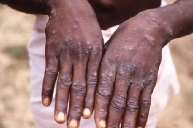 7 Kasus Monkeypox di Jakarta Seluruhnya Laki-laki