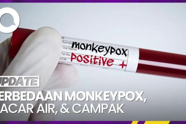 Beda Monkeypox dengan Cacar Air dan Campak
