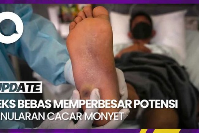 Mayoritas Penderita Cacar Monyet Ada Riwayat HIV, Ini Penjelasan Kemenkes