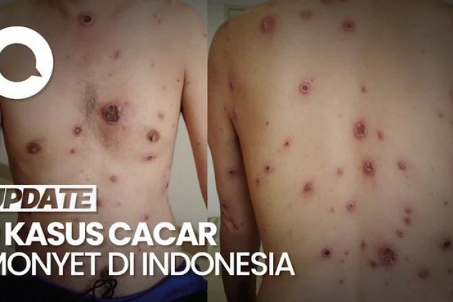 Fakta-fakta Cacar Monyet di Indonesia