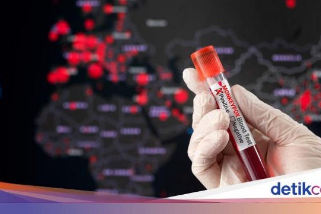 Dinkes DKI: 10 Kasus Positif Cacar Monyet Tertular Lewat Kontak Seksual