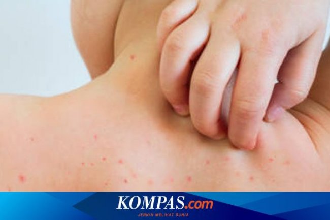 Kasus Cacar Monyet di Jakarta Terus Bertambah, Waspadai Gejala-gejalanya