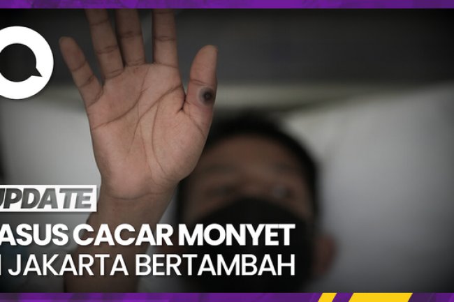 Bertambah Lagi, Kasus Cacar Monyet di Jakarta Kini 17 Orang