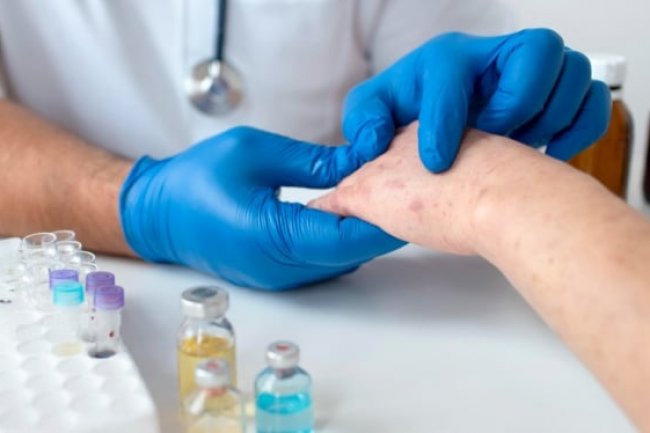 Penularan Cacar Monyet Disebut Lebih Lambat Dibanding Cacar Air, Begini Kata Dokter