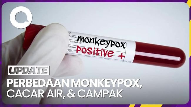 Beda Monkeypox dengan Cacar Air dan Campak