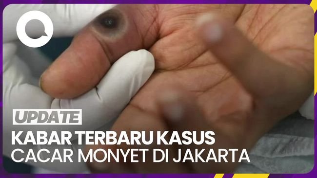 Update Kasus Cacar Monyet di Jakarta, Gejala hingga Prioritas Vaksin