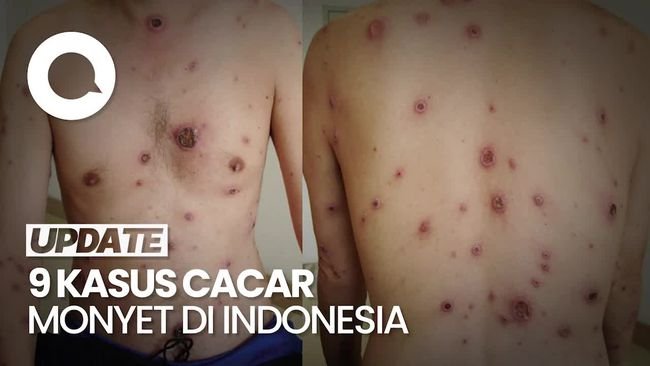 Fakta-fakta Cacar Monyet di Indonesia