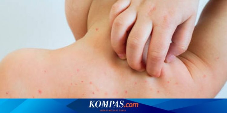 Kasus Cacar Monyet di Jakarta Terus Bertambah, Waspadai Gejala-gejalanya