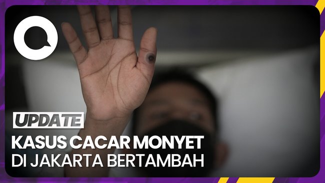 Bertambah Lagi, Kasus Cacar Monyet di Jakarta Kini 17 Orang