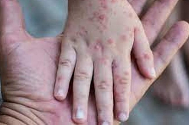 Pemkot Probolinggo Minta Masyarakat Waspada Penyakit Cacar Monyet, Kenali Gejalanya