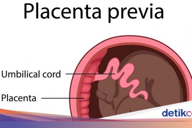 Plasenta Previa: Jenis, Penyebab, Gejala, dan Cara Mencegahnya