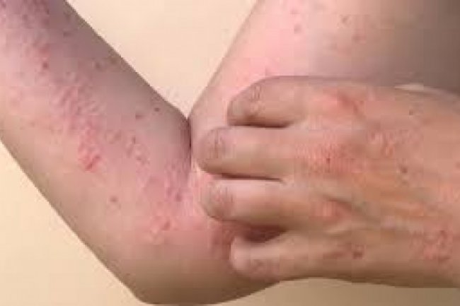 Fakta-Fakta Cacar Monyet yang Menyerang Pelaku Menyimpang LGBT dan Homoseksual