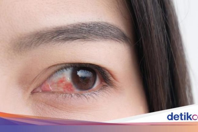 Kelopak Mata Sering Bengkak dan Nyeri, Bagaimana Mengatasinya Dok?