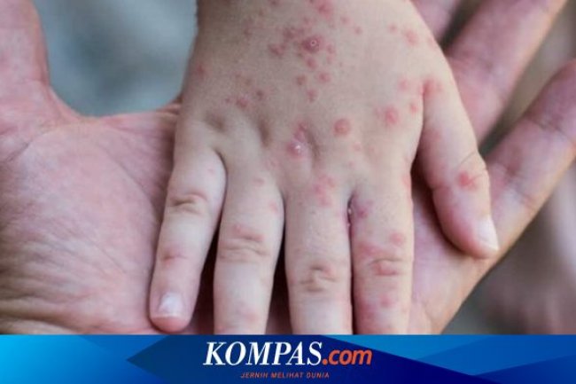 Dinkes DKI Sebut 20 Warga Terkonfirmasi Cacar Monyet Masih Diisolasi