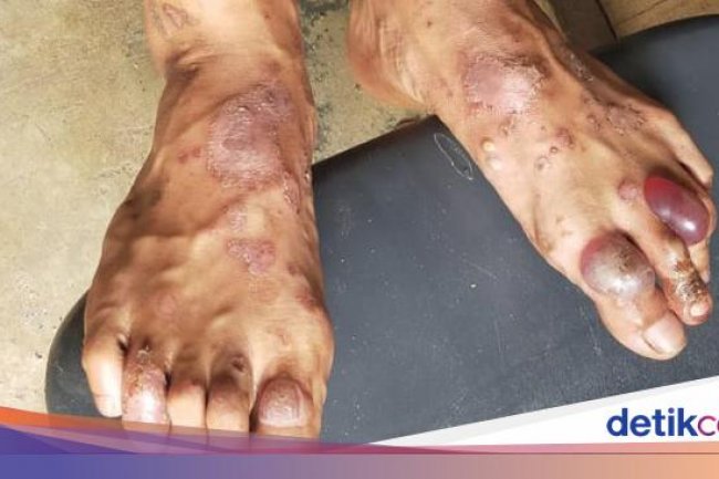 Ciri-ciri Cacar Monyet, Gejala, Penyebab, dan Penanganannya