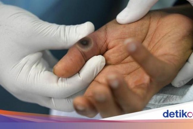 Total Sudah 51 Kasus Mpox di RI, Semuanya Tertular Lewat Seks