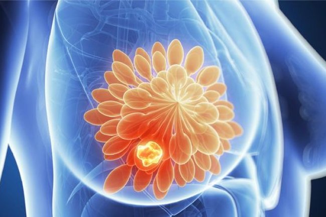 Biopsi VABB, Deteksi Dini Kanker Payudara Minimal Invasif dan Akurat