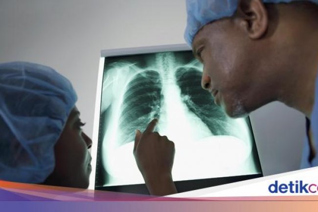 Ngeri! Paru-paru Wanita 22 Tahun Kolaps, Ukurannya Menyusut 80 Persen
