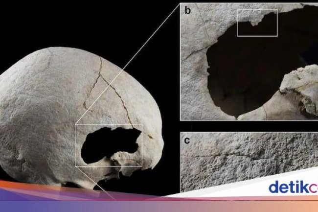 Perempuan dari 4.500 Tahun Lalu Ini Selamat dari Operasi Tengkorak, tapi...