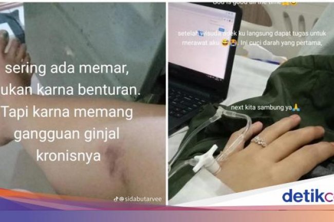 Viral Wanita Gagal Ginjal Kronis Diduga gegara Sering Minum Obat, Dokter Bilang Gini
