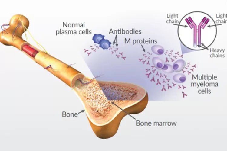 Mengenal Penyakit Multiple Myeloma, Penyakit Kanker yang BuatJurnalis Investigasi Arnold Diaz Meninggal Dunia