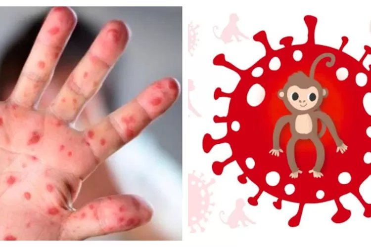 Dinkes Aceh Utara: Kenali Virus Monkeypox Atau Lebih Dikenal Virus Cacar Monyet